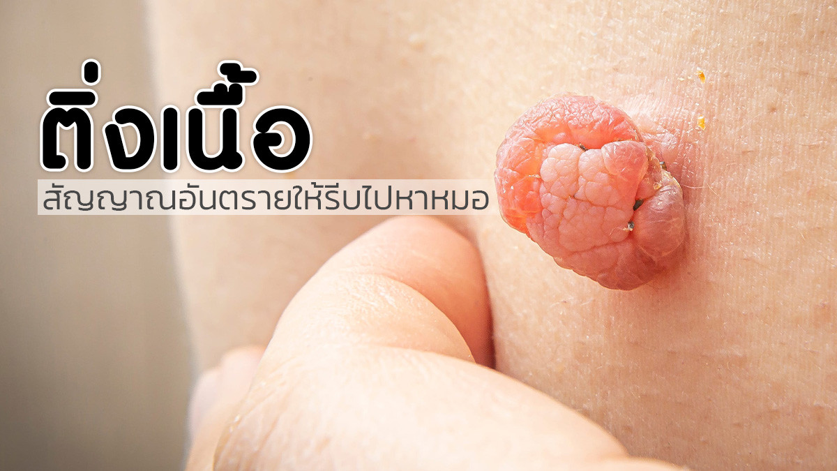 รูปภาพในบทความ สัญญาณอันตราย !! ติ่งเนื้อแบบไหนต้องรีบพบหมอ