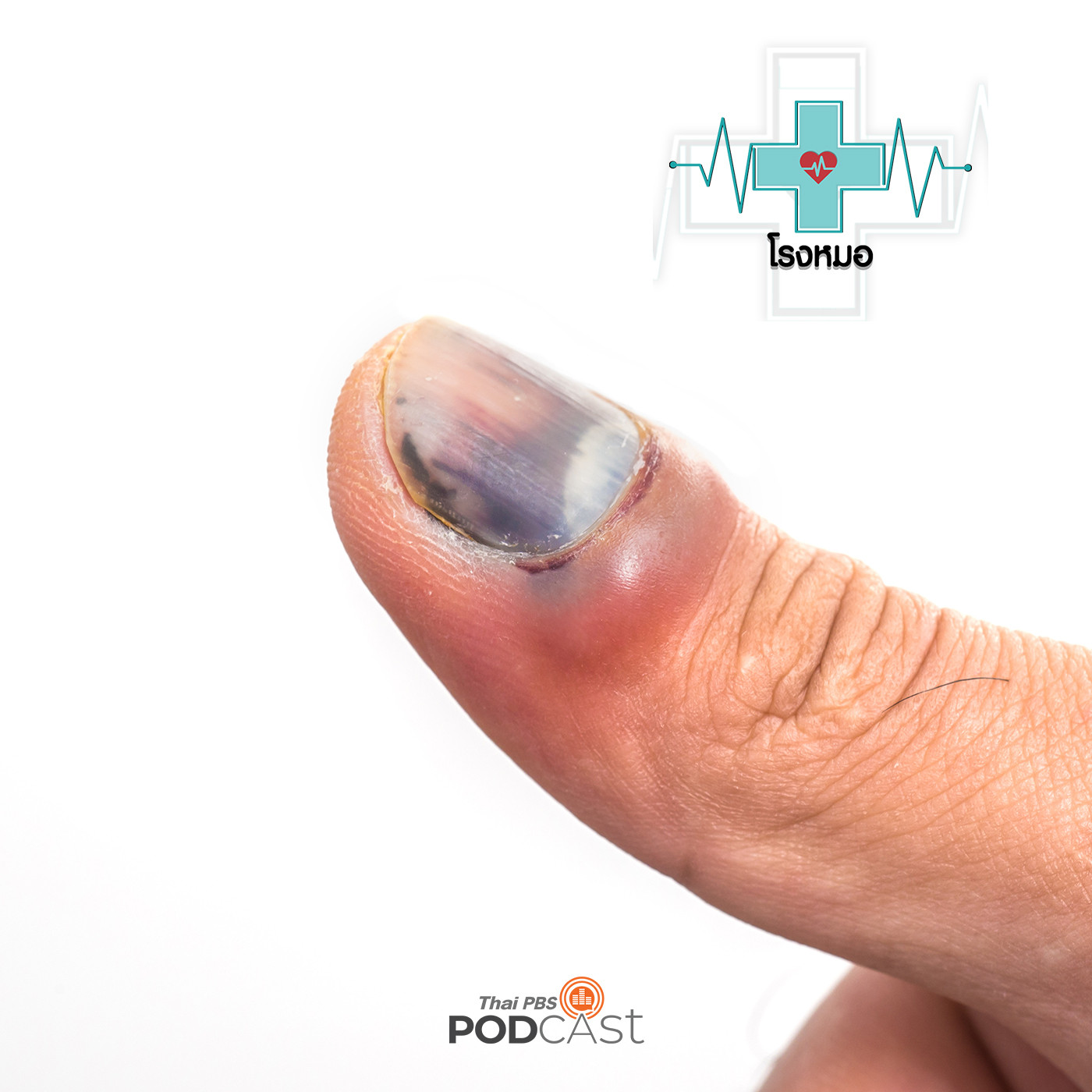 EP. 517: ประตูหนีบนิ้วเลือดออกใต้เล็บ แค่เจาะหรือต้องถอดเล็บ