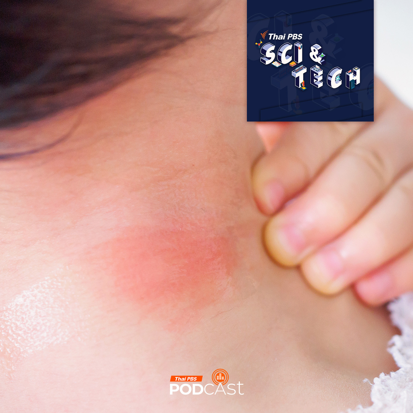 Sci & Tech EP. 850: เพราะอะไรร่างกายต้อง "อักเสบ"