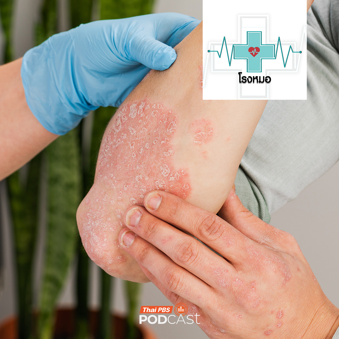 โรงหมอ EP. 1128: โรคสะเก็ดเงิน รักษาได้แต่ไม่หายขาด