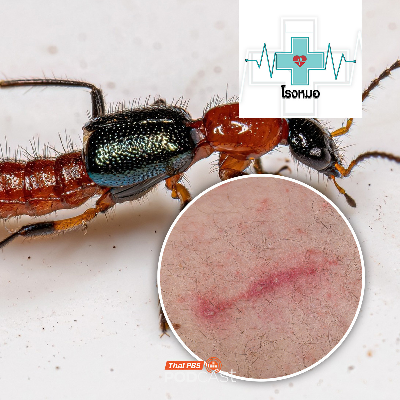 โรงหมอ EP. 1147: แมลงก้นกระดก ตัวเล็กแต่ร้าย พิษเป็นกรด