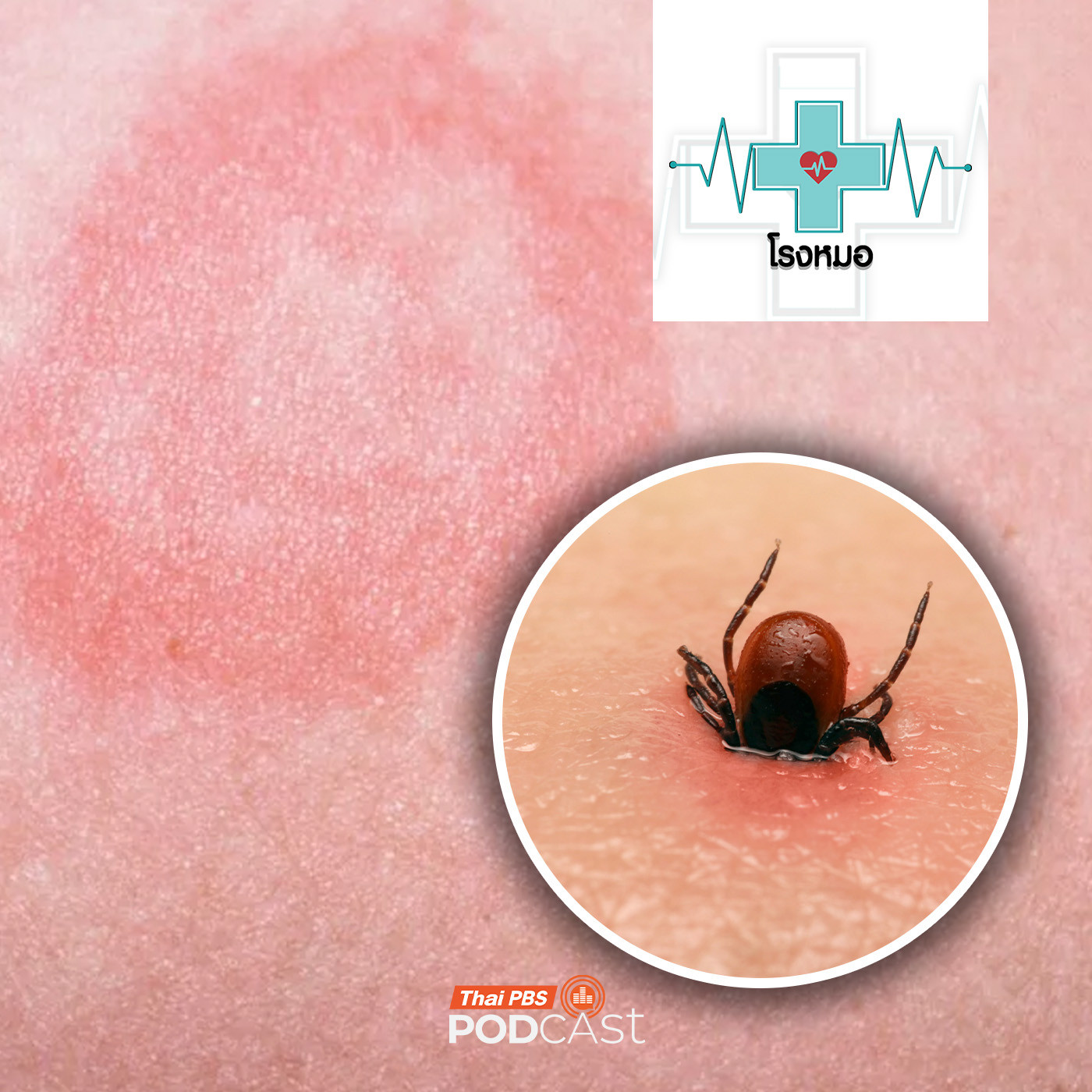 EP. 1170: "ไลม์" โรคจากเห็บ เป็นแล้วเหมือนไม่มีอะไร ไม่รักษาเสี่ยงตายได้