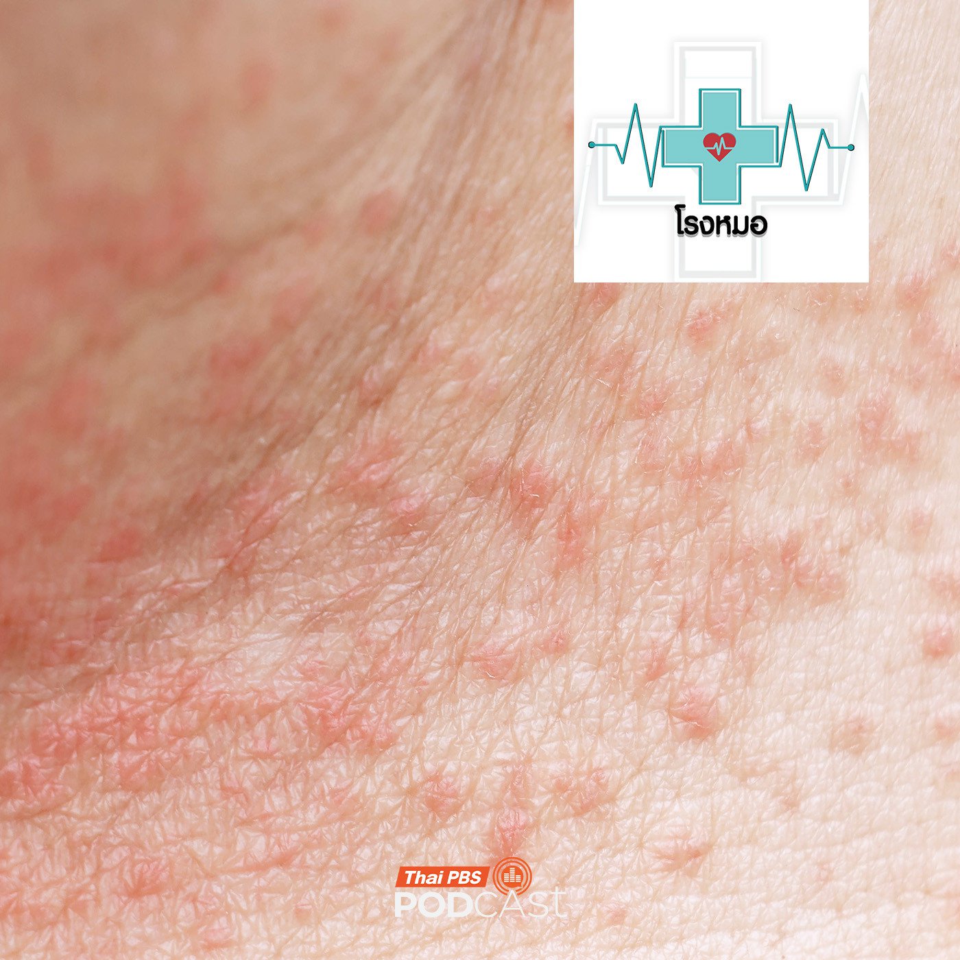 EP. 1199: ผดร้อน โรคผิวหนังในหน้าร้อน