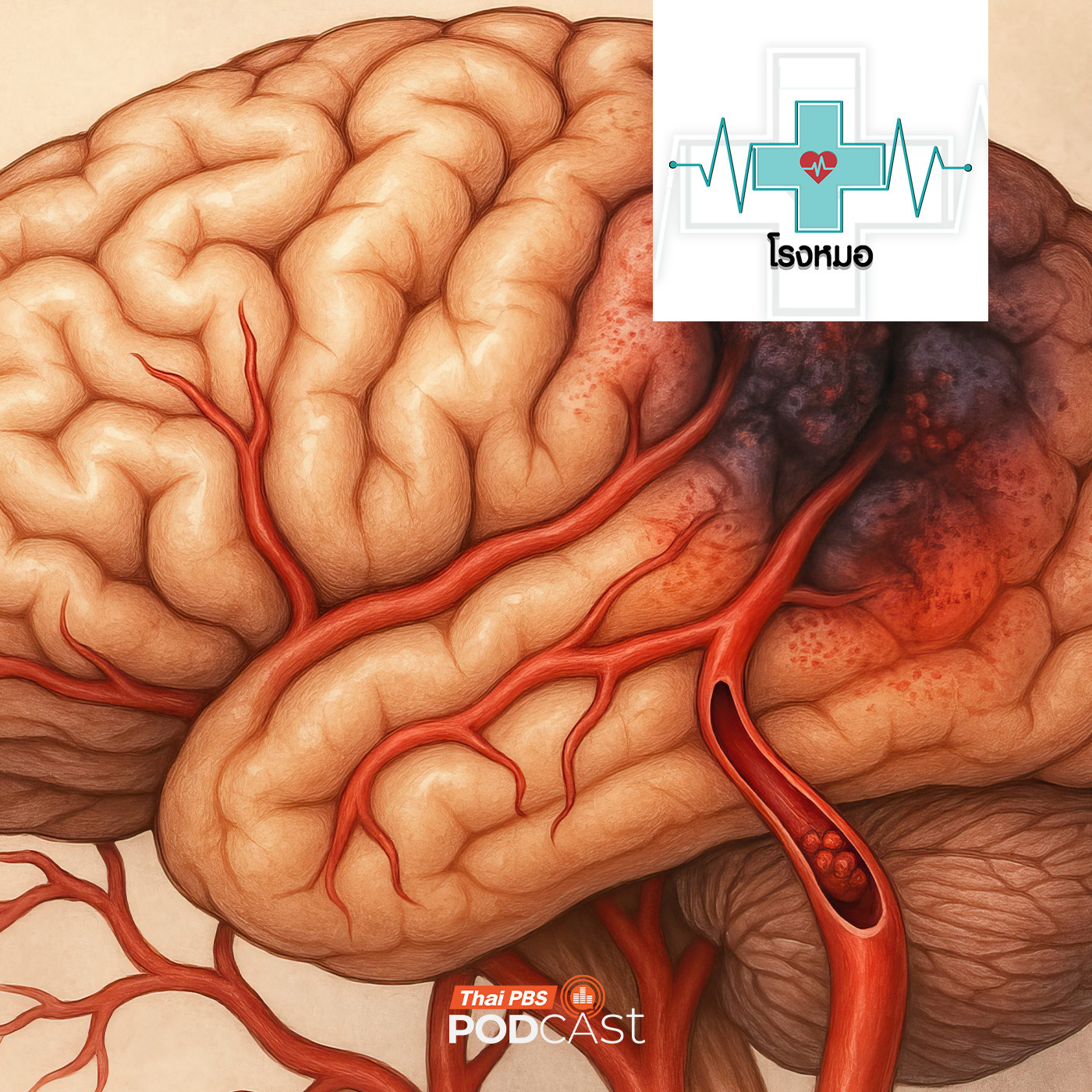 EP. 1204: เปิดความจริง "สโตรก" ภัยเงียบที่ไม่เลือกอายุ... ทำไมคนรุ่นใหม่ถึงเป็นกันมากขึ้น ?