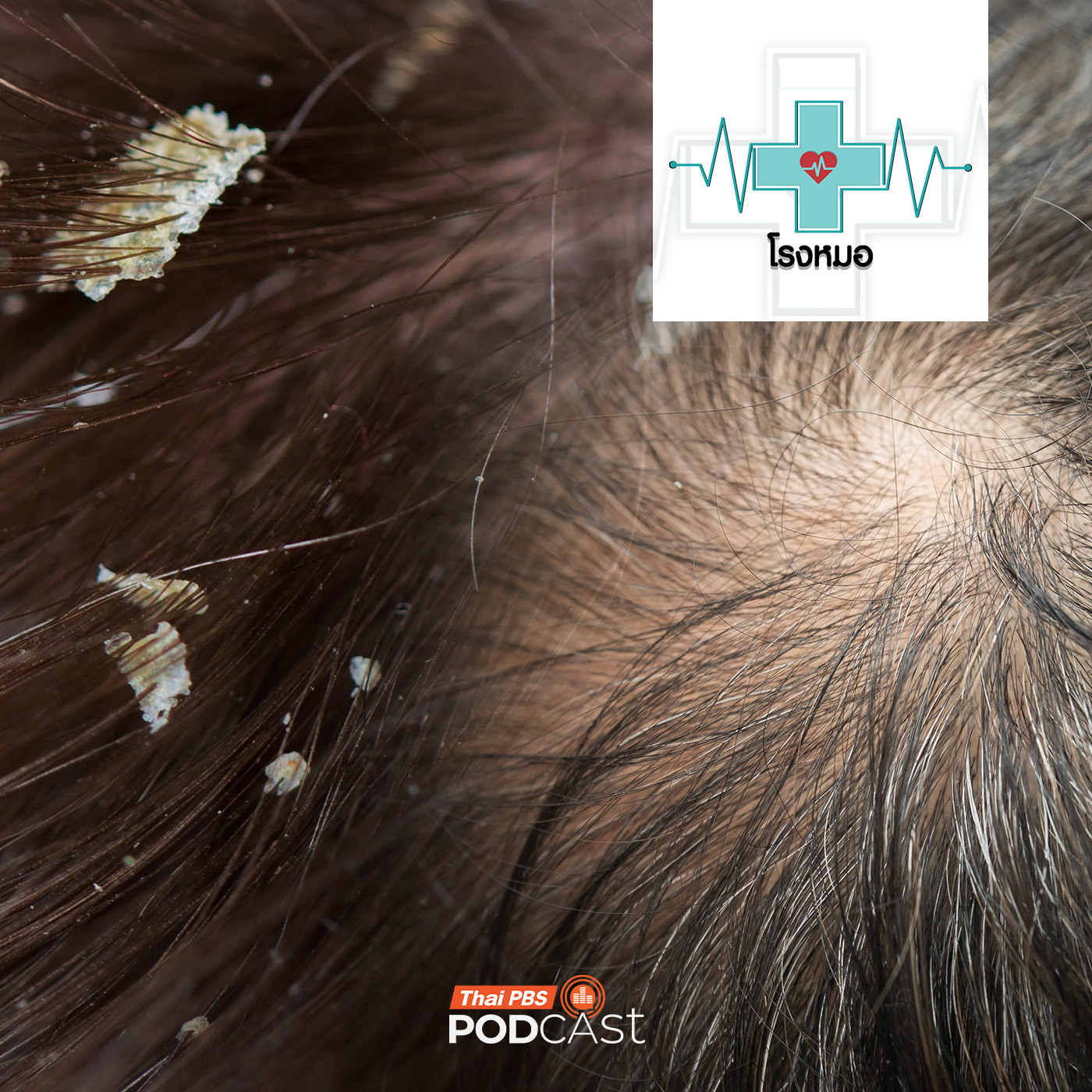 EP. 1209: เคลียร์ชัด "โรคหนังศีรษะ" รังแค ผมบาง หัวล้าน รู้ก่อนป้องกันได้รักษาทัน